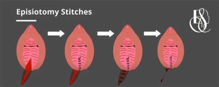 How painful is episiotomy?