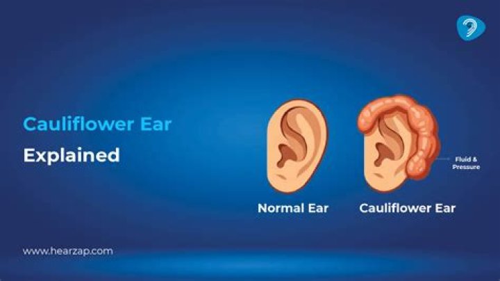 Is a cauliflower ear permanent?