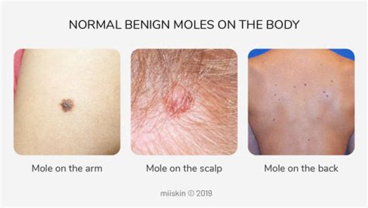 Is it normal to get new moles?