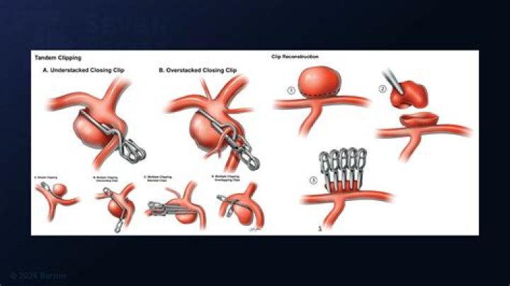 Is it normal to have seizures after a craniotomy?