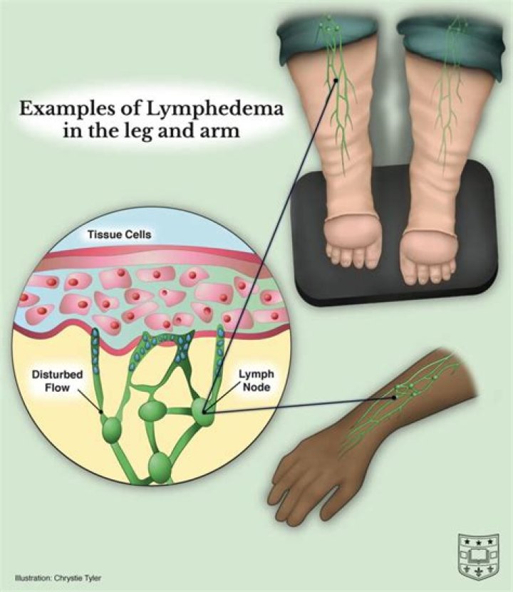Is lymph node removal necessary for melanoma?