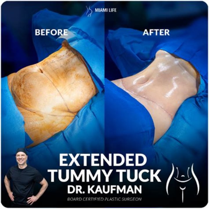 Should I be scared to get a tummy tuck?