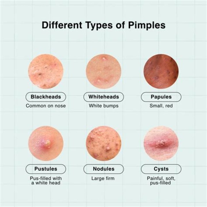 Should I pop a green pimple?