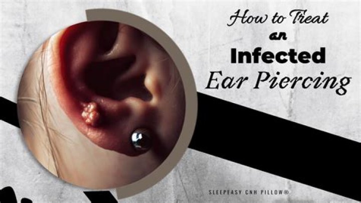 Should I remove infected piercing?