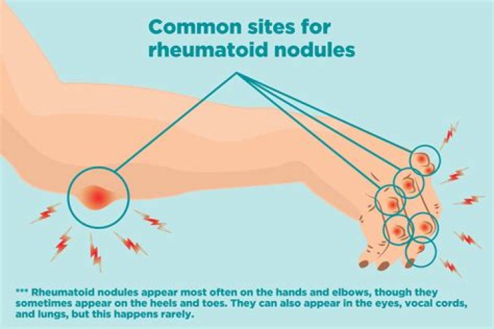 What are inflammatory nodules?
