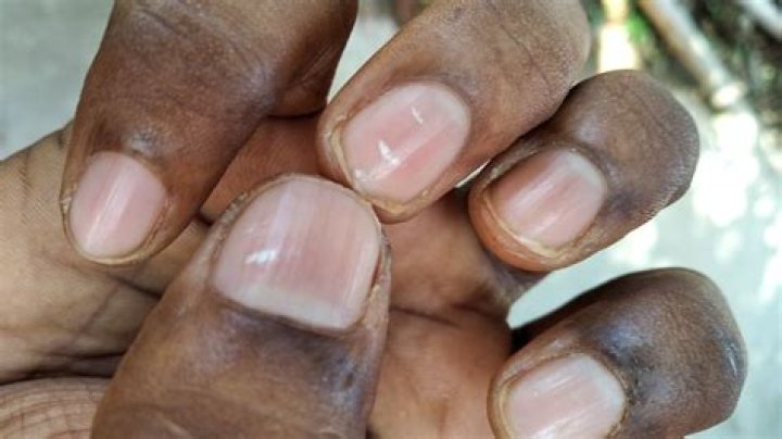 What are milk spots on nails?