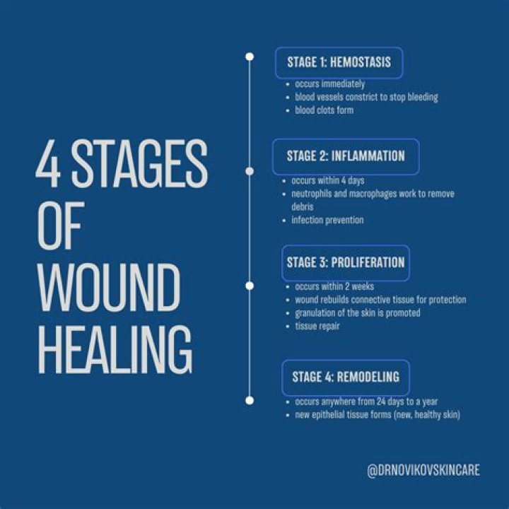 What are the 4 stages of acne?