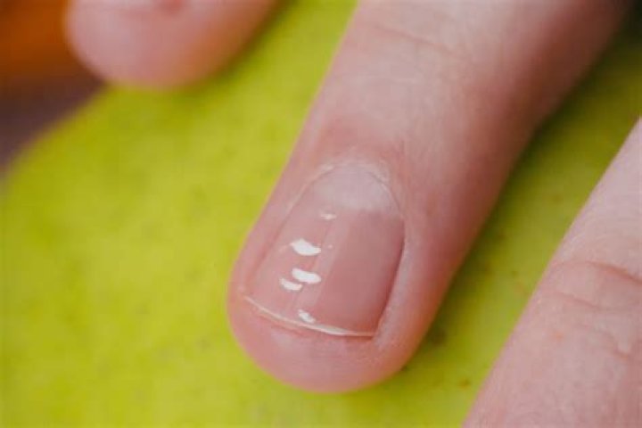 What are white spots on nails?