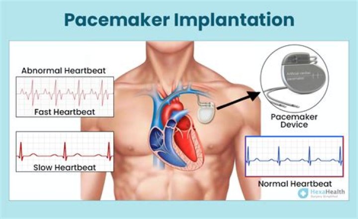 What can't you do after getting a pacemaker?