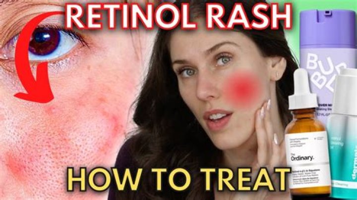 What causes tretinoin glow?