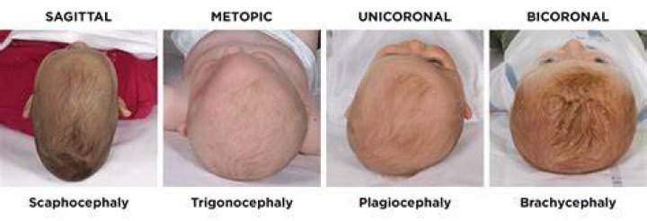 What doctor treats craniosynostosis?