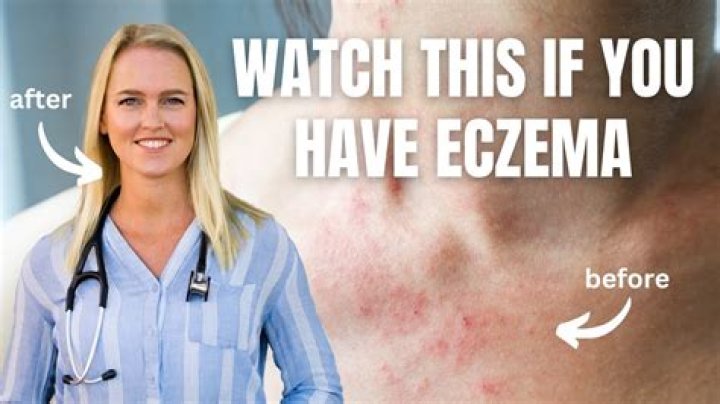 What fruit is good for eczema?