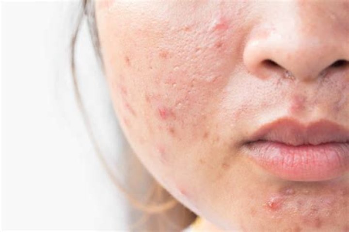 What happens if you leave acne untreated?