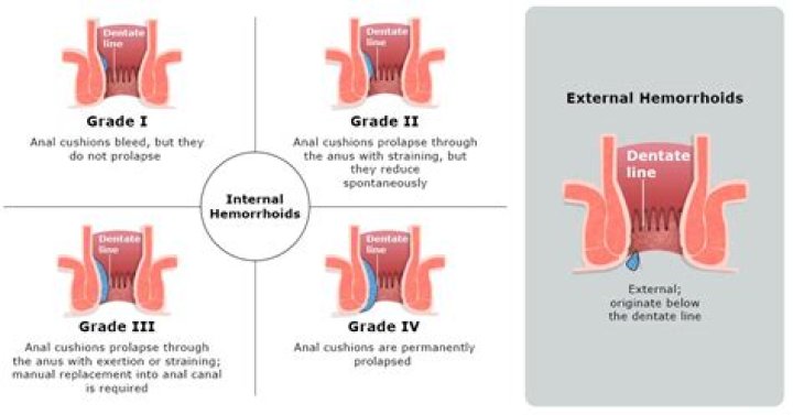 What is a large hemorrhoid?
