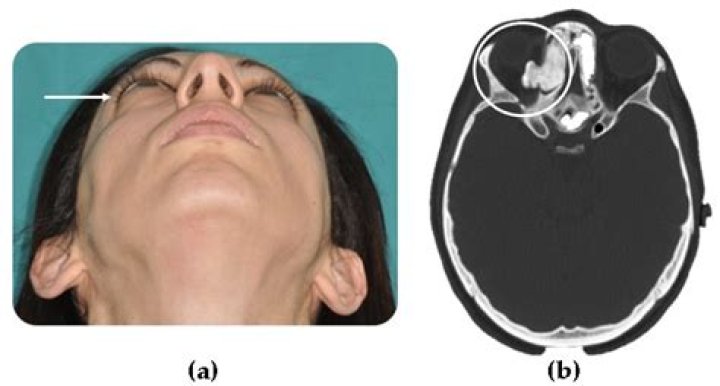 What is an osteoma of the skull?