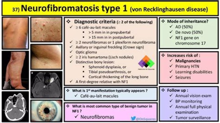 What is iris hamartoma?