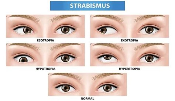 What is it like to have strabismus?