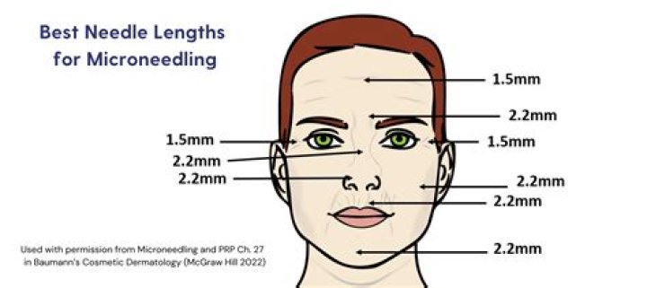 What is the best type of microneedling?