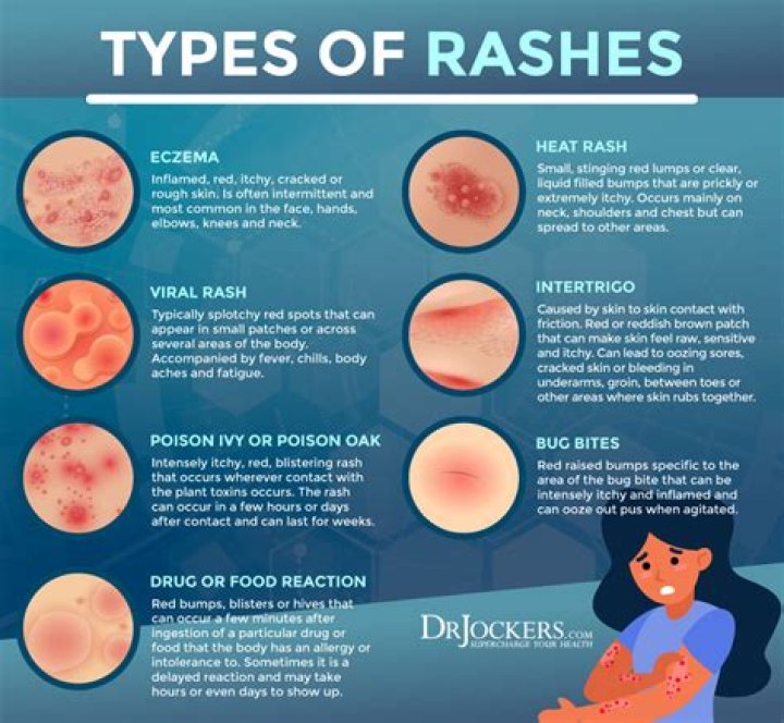 What is the most common rash?