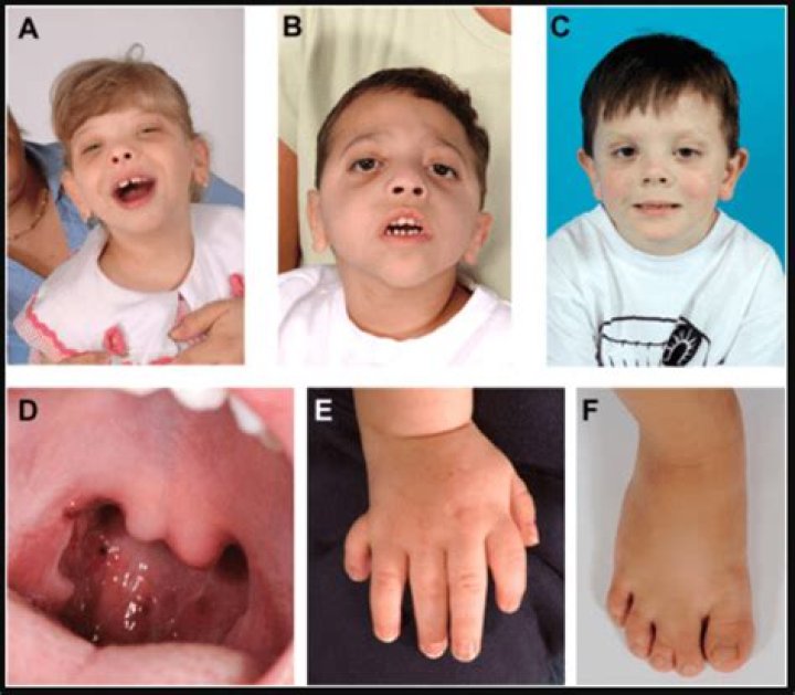 What is the rarest genetic trait?