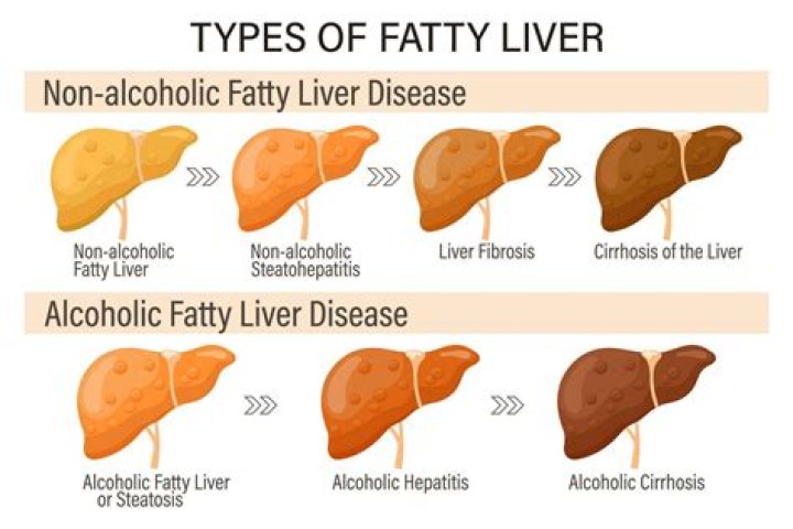 What level of ALT is cirrhosis?