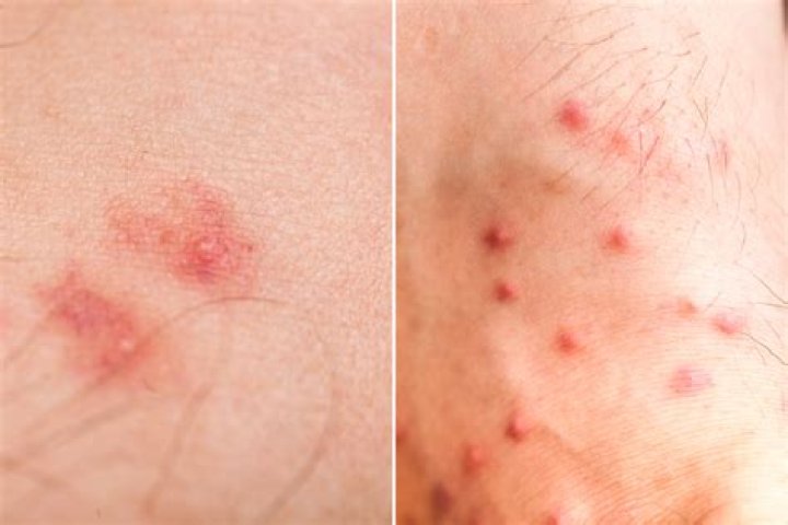 Where do fleas bite humans?
