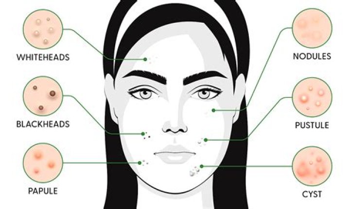 Which oil is best for acne and pimples?
