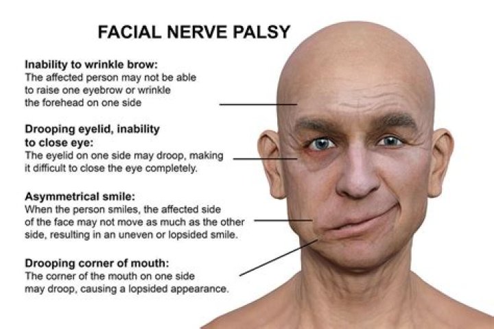 Which side of your face droops in a stroke?