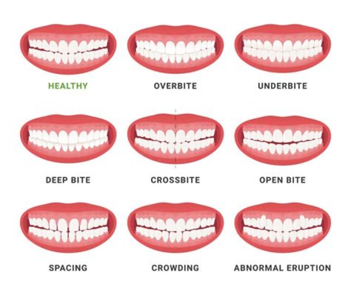 Why are my teeth crossing over?