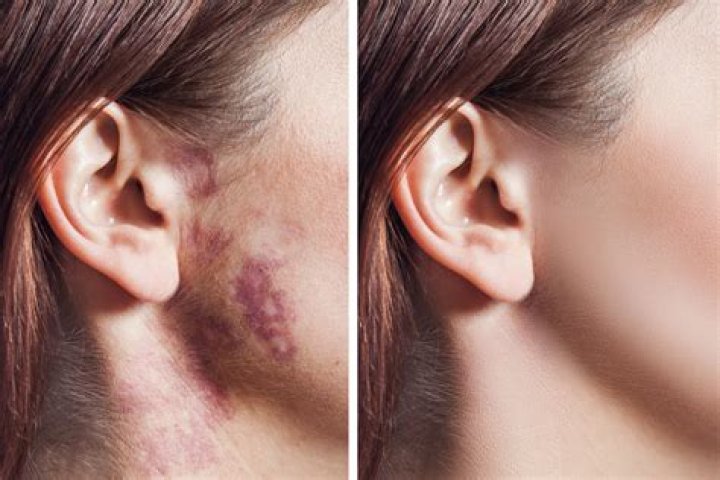 Why do birthmarks happen?