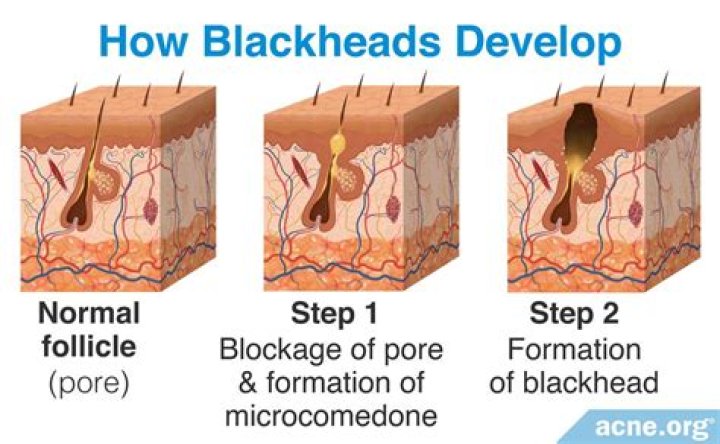 Why do blackheads come back?