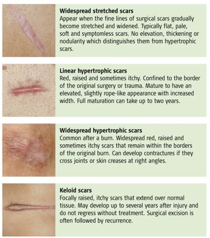 Why do some scars not fade?
