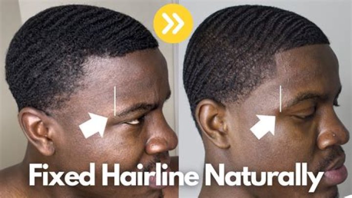 Why is my hairline V-shaped?