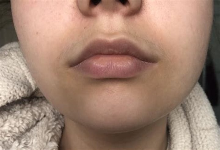 Why is the skin around my mouth a different color?